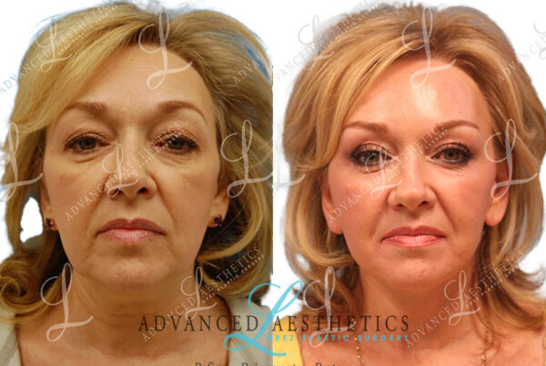 A woman's face before and after a facelift in San Antonio.