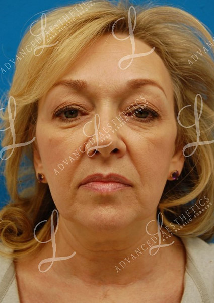a woman's face before a facelift surgery in San Antonio