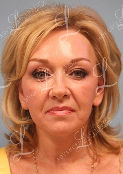 a woman's face after a facelift surgery in San Antonio