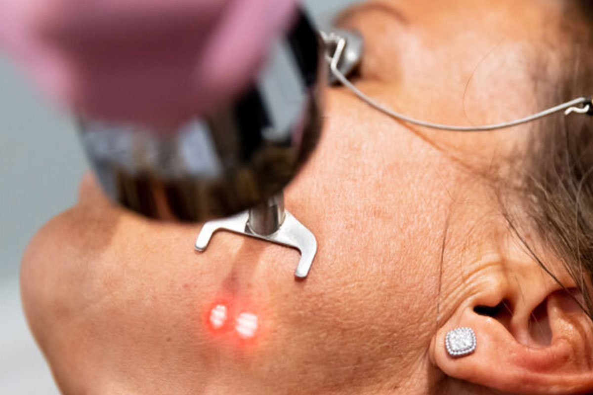 a close up of a woman's face receiving CO2 laser in San Antonio